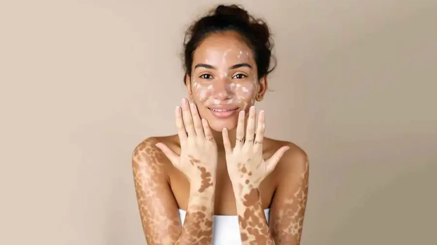 Vitiligo